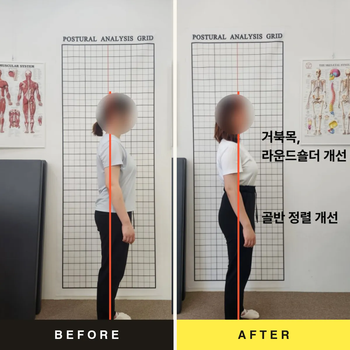 바디네이션 체형교정 전후 - 거북목·라운드숄더